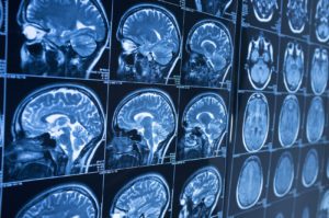 Head x-ray, brain in MRI