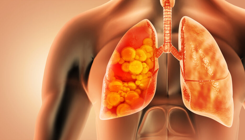 Symptoms of Popcorn Lung