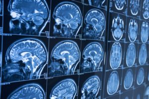 Categorizing a Brain Injury After an Accident in Edmond