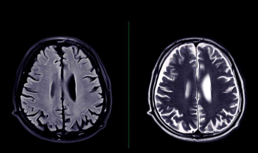 Chronic traumatic encephalopathy