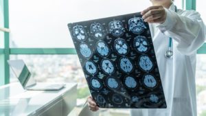 How Our Oklahoma City Truck Accident Lawyers Can Help Recover Compensation for a Brain Injury